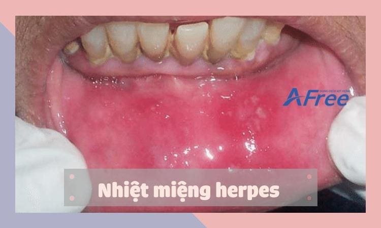  nhiet-mieng-the-herpes